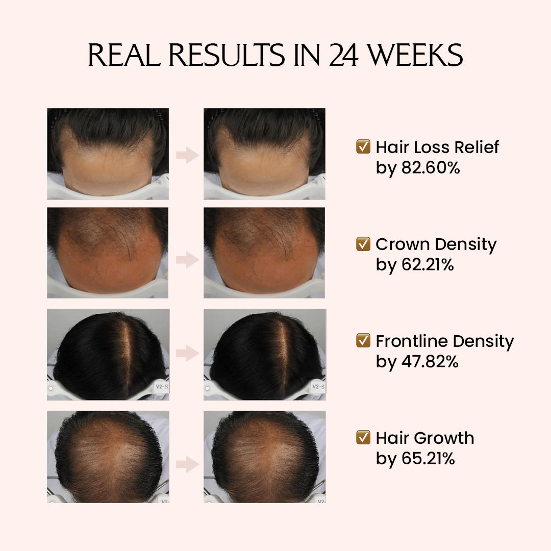 Lador Dermatical Hair- Loss Treatment (For Thin Hair)